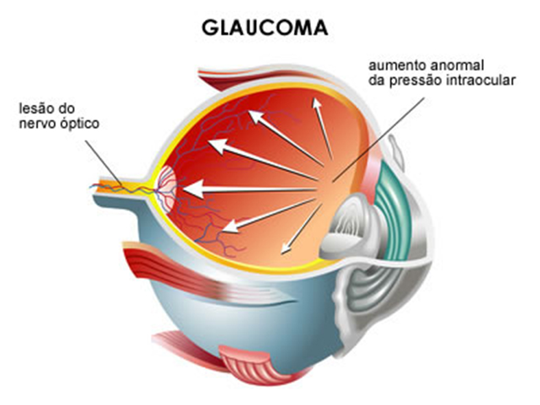 .: Maior de 60 :. - O que é Glaucoma, sintomas e diagnóstico